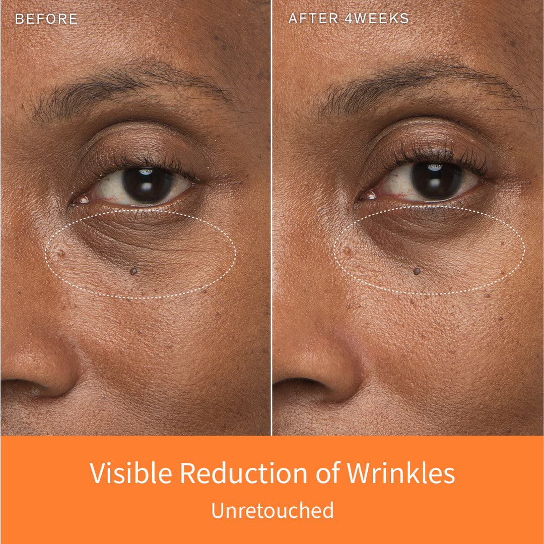 Before and after comparison after 4 weeks of a visible reduction of wrinkles