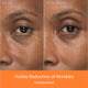 Enlarge image of Before and after comparison after 4 weeks of a visible reduction of wrinkles