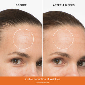 Before & after comparison after 4 weeks featuring a visible reduction of wrinkles on the forehead