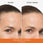 Before & after comparison after 4 weeks featuring a visible reduction of wrinkles on the forehead