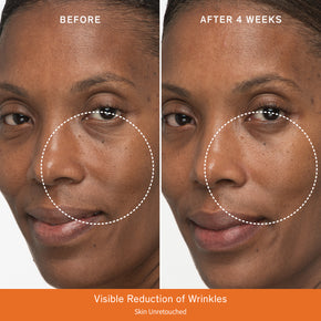 Before and after comparison after 4 weeks of a visible reduction of wrinkles on the cheek area